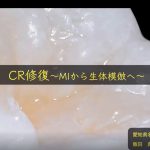 ICEED歯科臨床コース受講（ダイレクトボンディング）　「大阪府豊中市岡町の歯医者・歯科審美学会認定医・まつもと歯科」